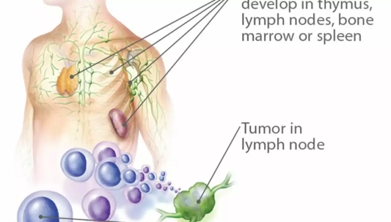 Cell Lymphoma: How to Advocate for Your Health